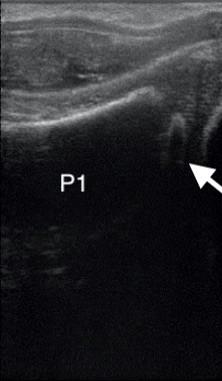 ultrasound image of P1 in a horse fetus showing proximal ossification